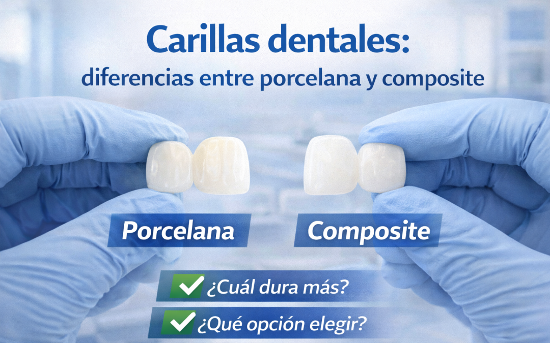 Carillas dentales: diferencias entre porcelana y composite