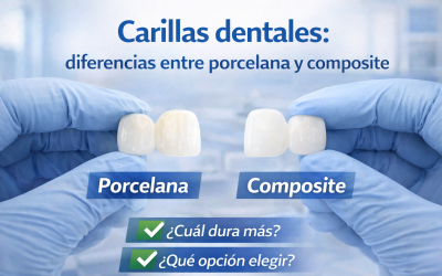 Carillas dentales: diferencias entre porcelana y composite