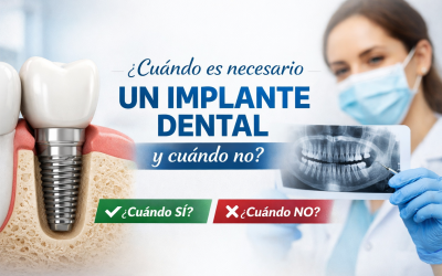 ¿Cuándo es necesario un implante dental y cuándo no? 7 Claves que Debes Conocer
