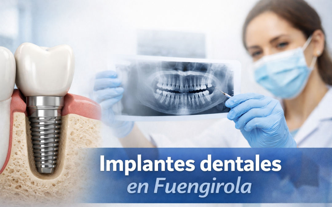 Implantes dentales en Fuengirola: proceso paso a paso y tiempos reales