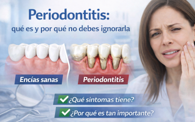 Periodontitis: qué es y por qué no debes ignorarla