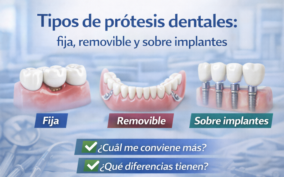 Tipos de prótesis dentales: fija, removible y sobre implantes
